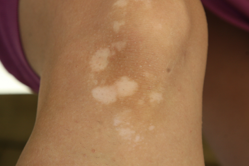 Pano branco: infecção de pele é comum no verão