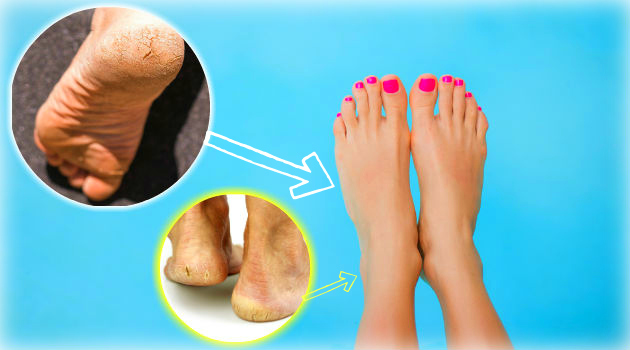 Podóloga indica substituto ideal para lixa de pé: deixa macio sem engrossar depois