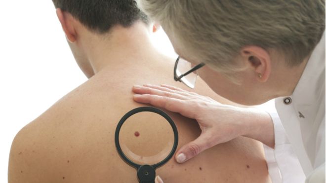 Câncer de pele pode ser confundido com lesões comuns ou psoríase